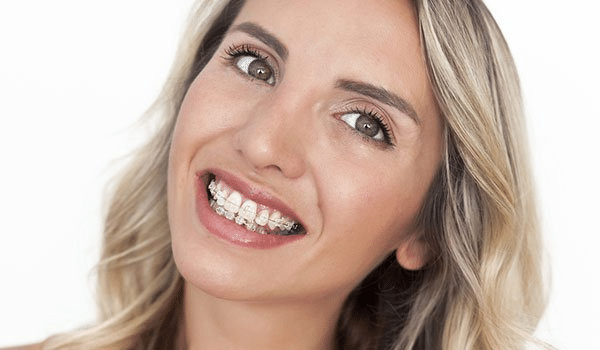 5 Reasons to Consider Adult Braces Smile Elements