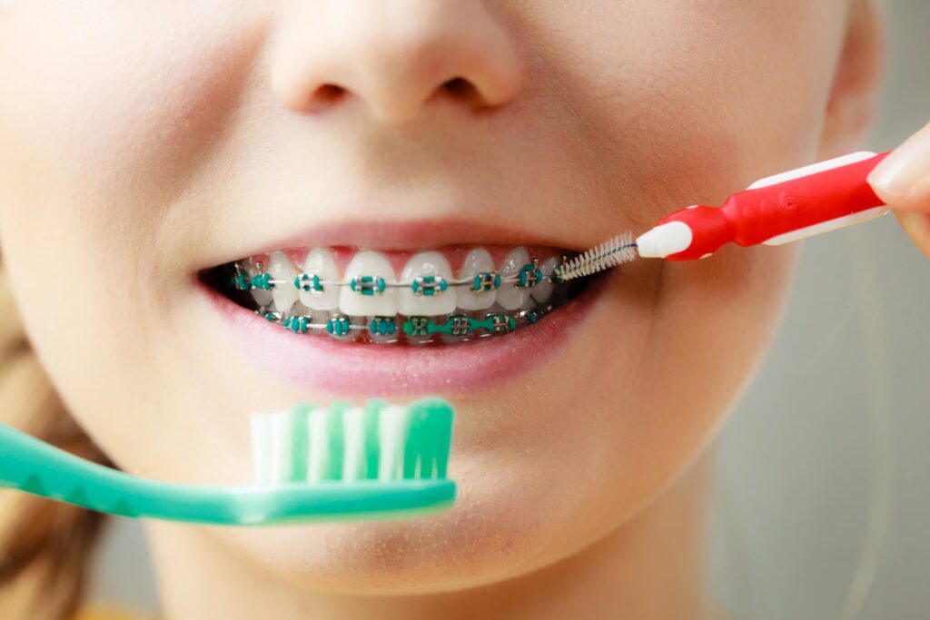 Life with Braces Tips for Eating, Oral Hygiene, and Adjusting Smile