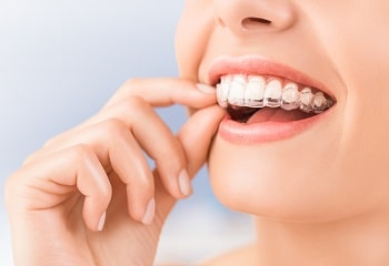 Clear Aligners Cost