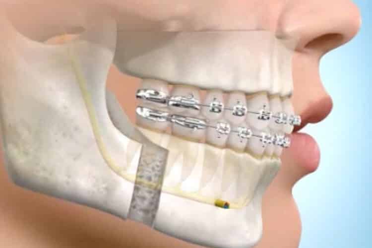 Orthodontics and Sleep Apnea