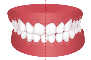 orthodontics and crossbite