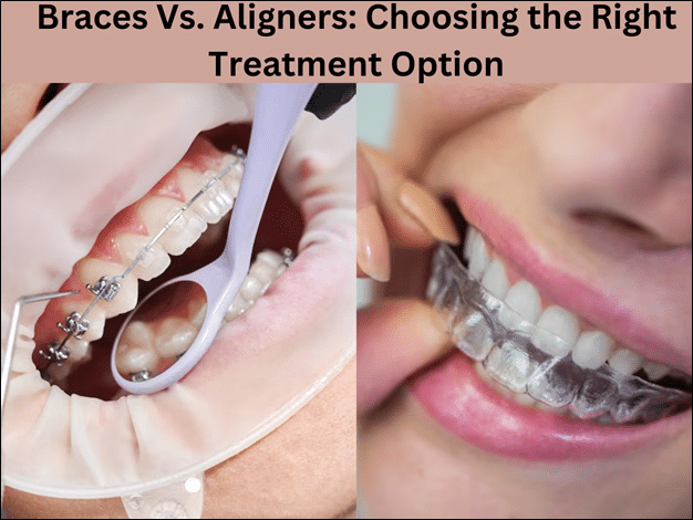 Braces Vs. Aligners: Choosing the Right Treatment Option